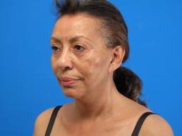 facelifts-macon facelifts-macon