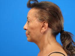 facelifts-macon facelifts-macon