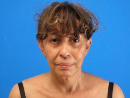 facelifts-macon facelifts-macon