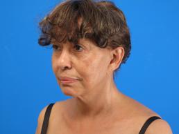 facelifts-macon facelifts-macon