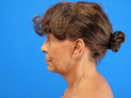 facelifts-macon facelifts-macon