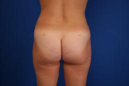 fat-injection-buttock-macon fat-injection-buttock-macon