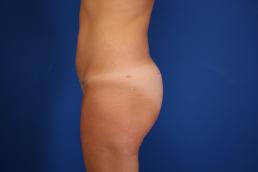 fat-injection-buttock-macon fat-injection-buttock-macon