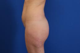 fat-injection-buttock-macon fat-injection-buttock-macon