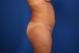fat-injection-buttock-macon fat-injection-buttock-macon