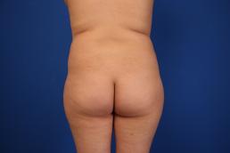 fat-injection-buttock-macon fat-injection-buttock-macon