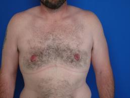 gynecomastia-macon gynecomastia-macon