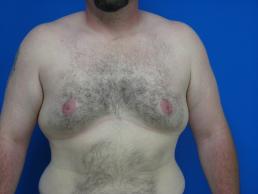 gynecomastia-macon gynecomastia-macon
