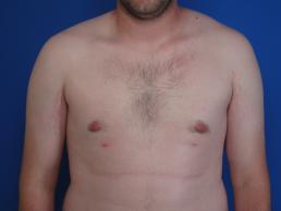 gynecomastia-macon gynecomastia-macon