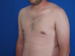 gynecomastia-macon gynecomastia-macon