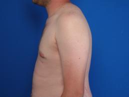 gynecomastia-macon gynecomastia-macon