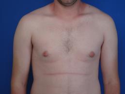 gynecomastia-macon gynecomastia-macon