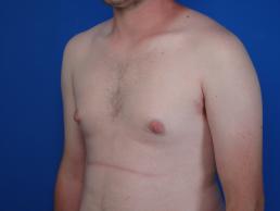 gynecomastia-macon gynecomastia-macon