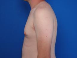 gynecomastia-macon gynecomastia-macon