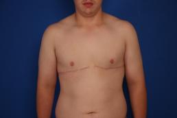 gynecomastia-macon gynecomastia-macon
