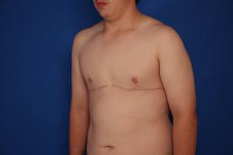 gynecomastia-macon gynecomastia-macon