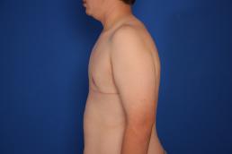 gynecomastia-macon gynecomastia-macon