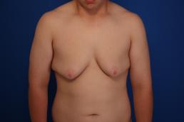 gynecomastia-macon gynecomastia-macon
