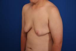 gynecomastia-macon gynecomastia-macon