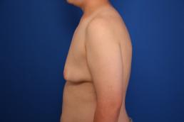 gynecomastia-macon gynecomastia-macon