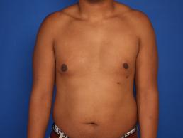 gynecomastia-macon gynecomastia-macon