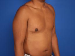 gynecomastia-macon gynecomastia-macon