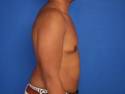 gynecomastia-macon gynecomastia-macon
