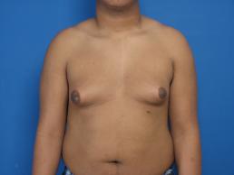 gynecomastia-macon gynecomastia-macon