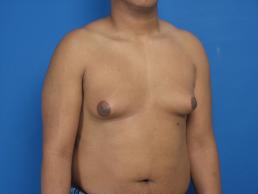 gynecomastia-macon gynecomastia-macon