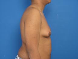 gynecomastia-macon gynecomastia-macon