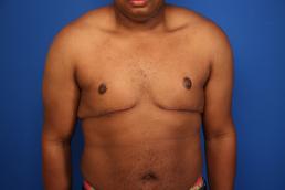 gynecomastia-macon gynecomastia-macon