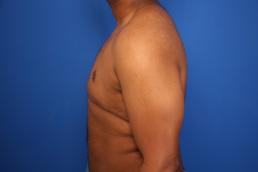 gynecomastia-macon gynecomastia-macon