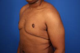 gynecomastia-macon gynecomastia-macon