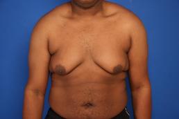 gynecomastia-macon gynecomastia-macon