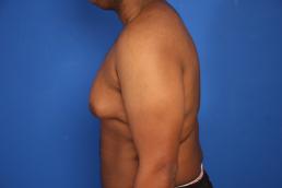 gynecomastia-macon gynecomastia-macon