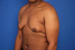gynecomastia-macon gynecomastia-macon