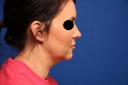 kybella-macon kybella-macon