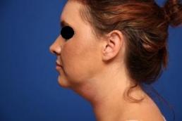 kybella-macon kybella-macon