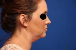 kybella-macon kybella-macon