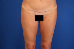 liposuction-macon liposuction-macon