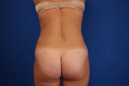 liposuction-macon liposuction-macon