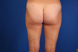 liposuction-macon liposuction-macon