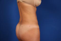 liposuction-macon liposuction-macon