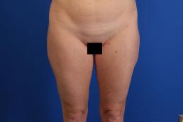 liposuction-macon liposuction-macon