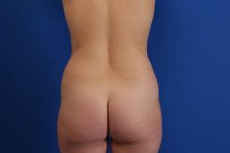liposuction-macon liposuction-macon