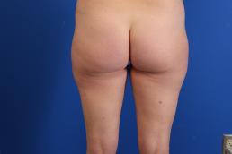 liposuction-macon liposuction-macon