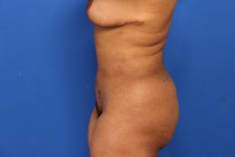 liposuction-macon liposuction-macon