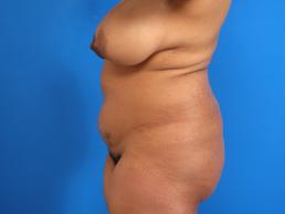 liposuction-macon liposuction-macon
