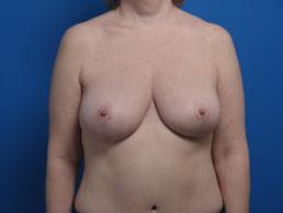 mastopexy-macon mastopexy-macon