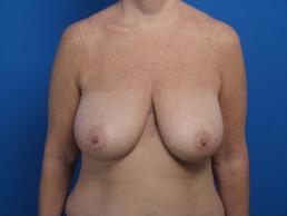 mastopexy-macon mastopexy-macon